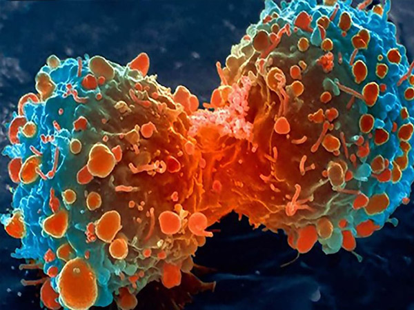 Các tế bào bị biến đổi do nhiễm xạ là nguyên bệnh u tuyến giáp